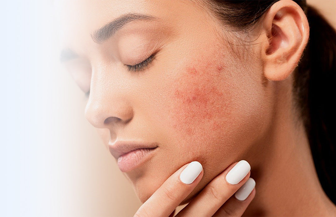 Rosacea Treatment.