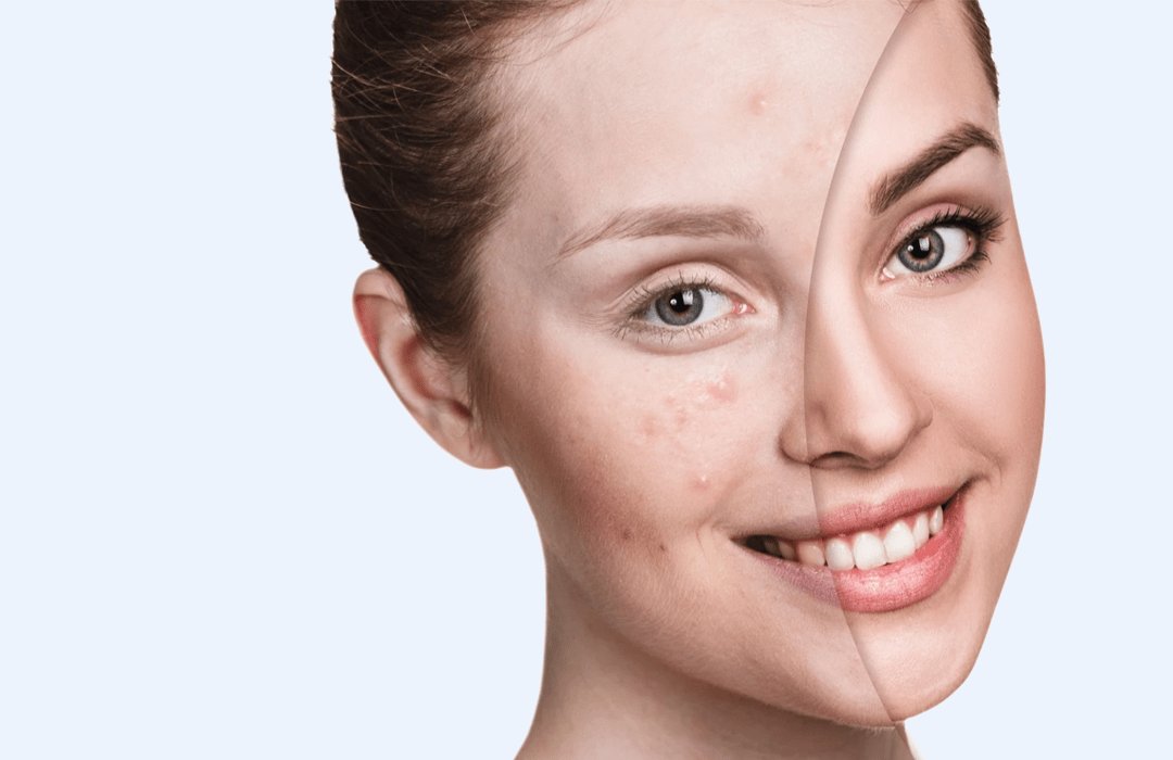 Acne Treatment