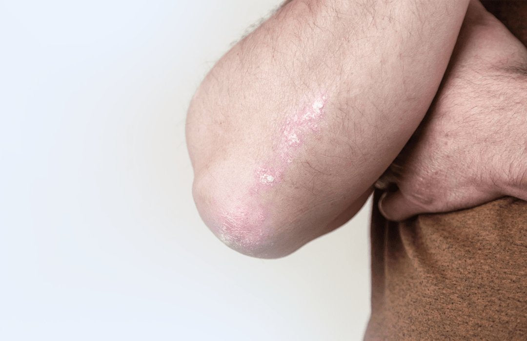 Eczema & Psoriasis