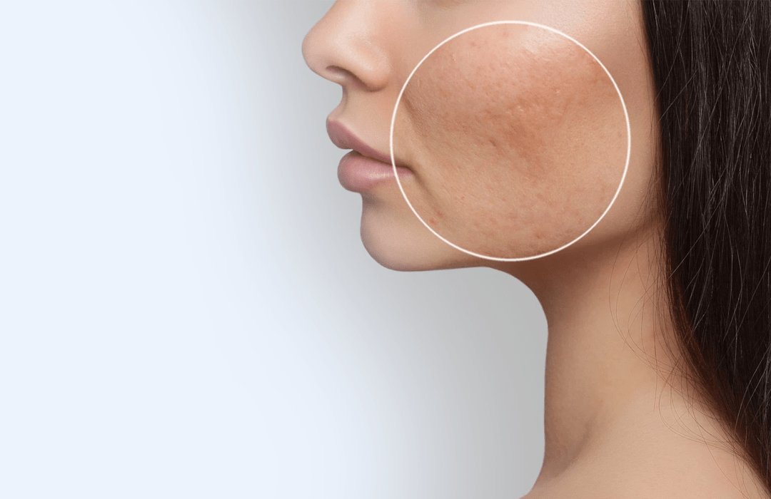 Buy Rosacea Treatment