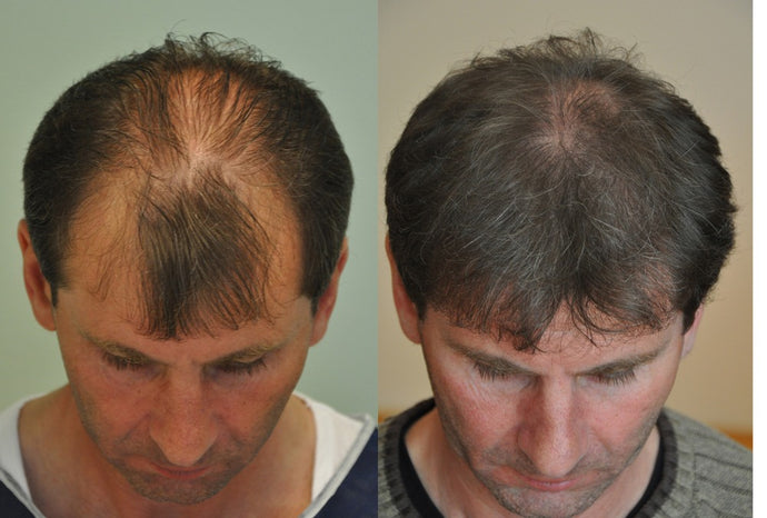 Can Male Pattern Hair Loss Be Reversed? Discover How