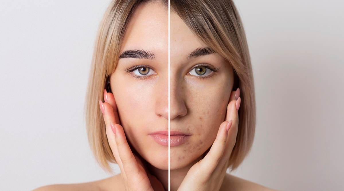 Does Pre Workout Cause Acne? Ultimate Guide