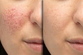 Understanding Rosacea: Symptoms and Management